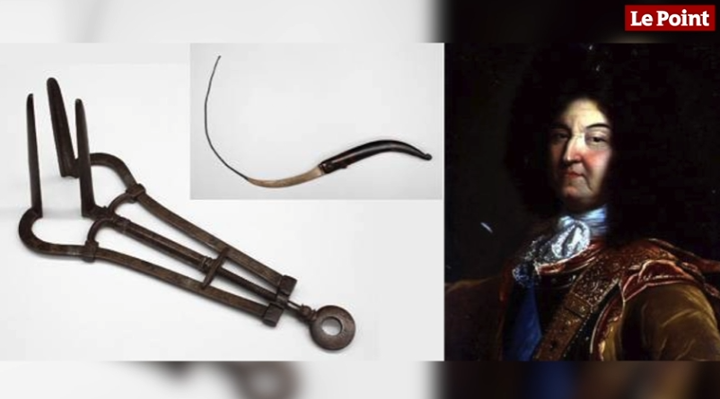 Fistule anale de louis XIV